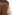 鼻尖形成術（自家軟骨移植） — ハイエンド美容外科クリニック