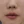โบท็อกซ์ร่นร่องริมฝีปาก (Lip Flip ทำให้ร่องใต้จมูกดูสั้นลง) — หลังทำ (7วัน) · คลินิก Younme