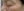 Surfect Lifting (4MHz monopolar RF lifting) — after (7days) · Le Shine Clinic