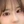 開眼角重修（開眼角修復手術） — 術後 (21天) · 娜娜醫美診所
