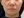 ยกกระชับ V-shape ด้วย HIFU (Shurink / Ultraformer III) — ก่อนทำ (30วัน) · Monster Clinic