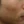 Surfect Lifting (4MHz monopolar RF lifting) — before (60days) · Only Lift Clinic