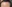 額縮小術（生え際下げ・ヘアライン下降術） — ザフィックス美容外科クリニック