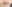 人中短縮（リップリフト） — ハイボム美容外科クリニック