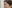 額（おでこ）のヒアルロン酸注入 — ロリポップ美容外科クリニック