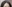額縮小術（生え際下げ・ヘアライン下降術） — スタート美容外科クリニック