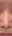 鼻尖形成（プロテーゼ・軟骨移植） — スケッチ美容外科クリニック