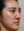 Thread embedding acupuncture lift (Korean-medicine 'maeseon' acupoint thread lift) — after · Garoseo Oriental Clinic - Gangnam Branch