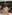 頬骨縮小術（全体／頬骨体部＋頬骨弓の骨切り） — ソダ美容外科クリニック