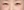 Insulated RF microneedle acne treatment (Agnes) — before (30days) · Remiel Plastic Surgery Clinic