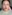 Double chin liposuction (submental liposuction) — Il Gong Gong Plastic Surgery Clinic