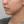 TuneLiner (non-invasive ultrasound fat reduction & contouring) — after (28days) · J.Fill Clinic - Gangnam Branch