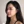 Nasal tip augmentation with donor (acellular) dermal matrix — before (14days) · Nabi Plastic Surgery Clinic