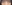 裏ハムラ法（経結膜的眼窩脂肪移動術） — ウィバース美容外科クリニック