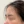 Ultracol (PDO microsphere collagen stimulator injection) — before (2days) · Project U Clinic