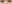 裏ハムラ法（経結膜的眼窩脂肪移動術） — ファクト美容外科クリニック