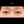 ผ่าตัดแก้ขนตาทิ่มตา (ขนตาแยงตา / เปลือกตาม้วนเข้า) — ก่อนทำ (7วัน) · รพ.ศัลยกรรมตกแต่งโอลโล