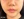 สลายไขมันใบหน้าด้วยเลเซอร์ (AccuSculpt) — หลังทำ (5วัน) · เออร์เน่คลินิก
