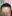 Forehead reduction (hairline lowering surgery) — Uri Plastic Surgery Clinic