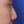 ผ่าตัดเอาสิ่งแปลกปลอมออกจากจมูก (เอาซิลิโคนจมูกออก) — ก่อนทำ (14วัน) · คลินิกโคบิจู