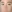 buried suture (non-incisional) double eyelid surgery — Chai Plastic Surgery