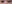 裏ハムラ法（経結膜的眼窩脂肪移動術） — アンド美容外科クリニック