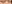 裏ハムラ法（経結膜的眼窩脂肪移動術） — ハッシュ美容外科クリニック