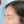 Ultracol (PDO microsphere collagen stimulator injection) — after (2days) · Project U Clinic