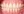 Clippy-C self-ligating ceramic braces (TOMY) — after (434days) · Yonsei Good Day Dental Clinic - Suseo Branch