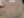 皮下分离术（Subcision，痘坑松解） — 术前 (60天) · The Ollim医美诊所