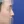 Short nose correction (nose lengthening / derotation) — before (9days) · Yeonse Kyeol Plastic Surgery Clinic