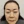 Thread lift — before · Beauty Blossom Clinic