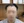 Hairline hair transplant (hairline lowering by grafting) — before (3days) · Vance Mosae Clinic