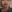 jaw angle reduction (mandibular angle osteotomy) — Eight Plastic Surgery Clinic