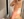 Arm liposuction — after (3days) · Barbie Line Clinic