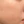 CryoCell (cryo-electrophoresis cooling + active-ingredient infusion; post-laser soothing care) — before (14days) · U&Me Clinic