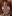 二重あごの脂肪吸引（顎下脂肪吸引） — A-Top美容外科クリニック