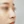 Nose tip filler — before · Erne Clinic