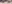涙袋形成（脂肪注入） — ファクト美容外科クリニック