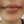 Full-face filler (full-face HA rejuvenation) — before · Shiny Clinic