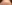 目尻切開 — ゼロワン美容外科クリニック