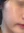 PRP skin rejuvenation (platelet-rich plasma therapy) — after (7days) · U&Me Clinic - Hongdae Branch