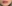 Lip filler (lip augmentation with HA) — Olliting Plastic Surgery Clinic