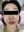 Accent Prime 電波音波拉提（Alma 艾森電熱刀系統） — 術前 (15天) · JD醫美診所