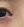 acne scar subcision / regenerative needling — before (60days) · Rodam Korean Medicine Clinic - Gangnam Branch
