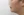 ตัดไขมันกระพุ้งแก้ม — ก่อนทำ (9วัน) · ไอรูมิ ศัลยกรรมพลาสติก
