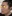 Bulbous nose correction (surgical nasal tip reduction) — Eight Plastic Surgery Clinic