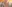 Double chin liposuction (submental liposuction) — Seoul During Clinic
