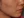 เลเซอร์ Fraxel (Fractional Laser) — ก่อนทำ (7วัน) · คลินิก Le Shine