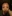 Forehead filler (hyaluronic acid) — Kody Plastic Surgery Clinic